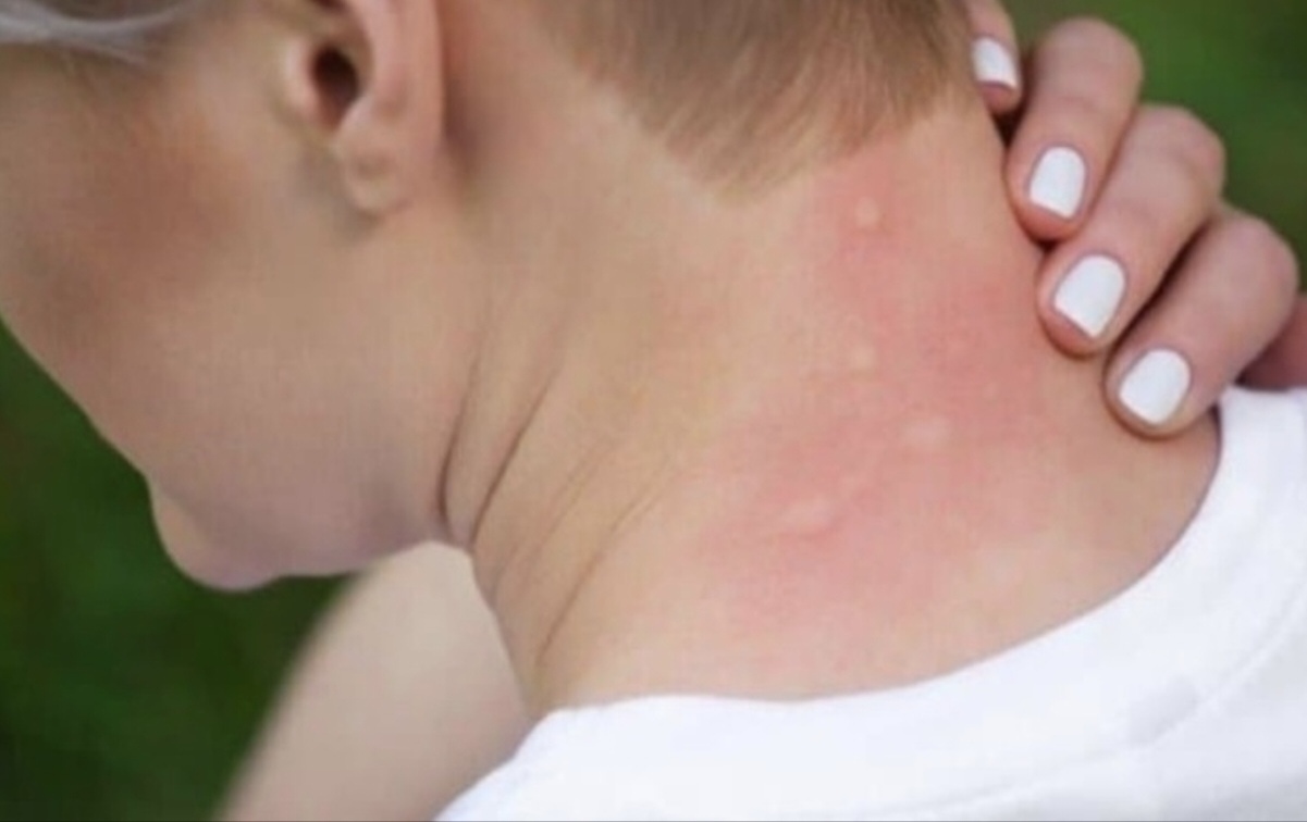 These People Are Most Likely to Be Bitten by Mosquitoes